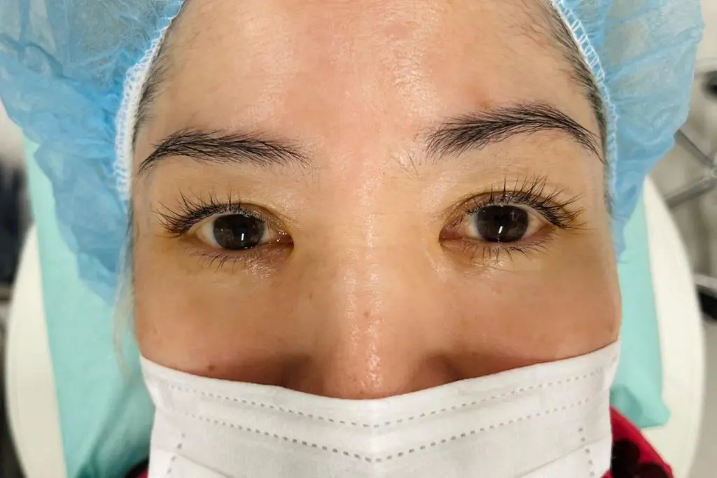 OurAge×Webエクラ  手術前写真