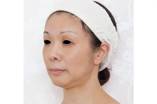 プロファイロ　施術前