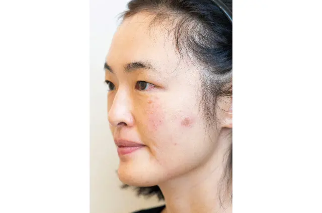 「初めてのシミとり」施術体験レポート①メの画像_3