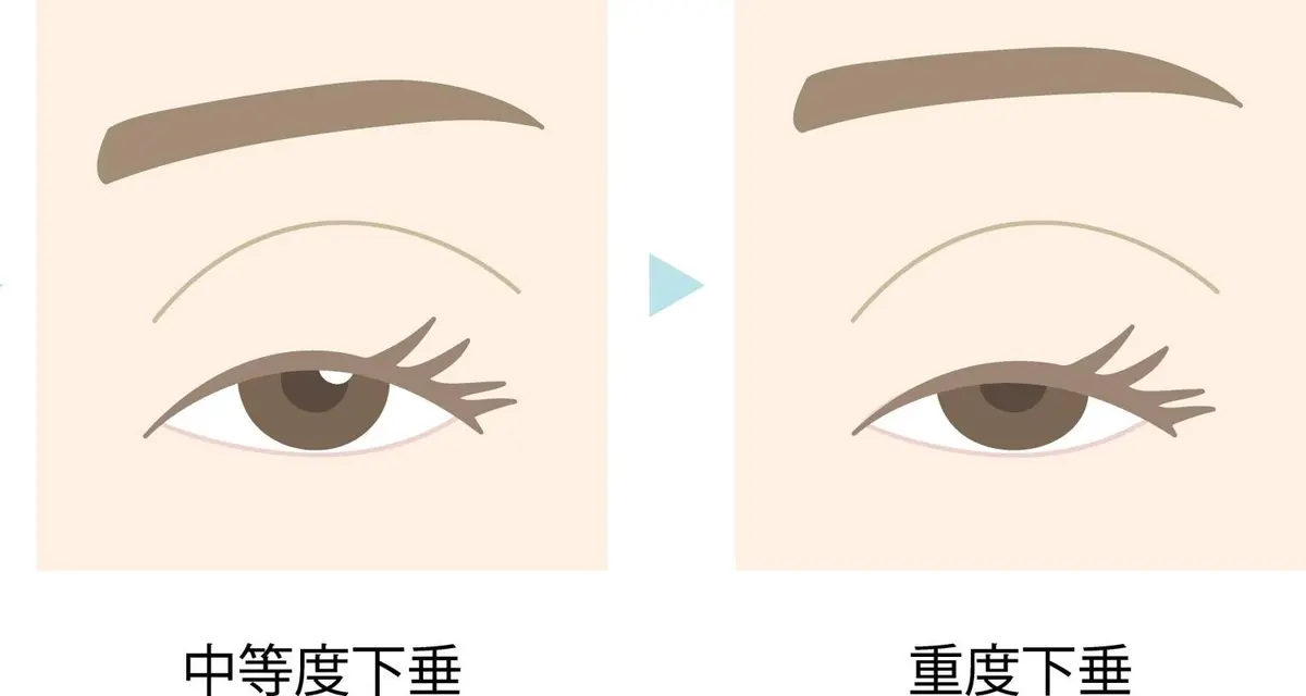 OurAge×Webエクラ　眼瞼下垂