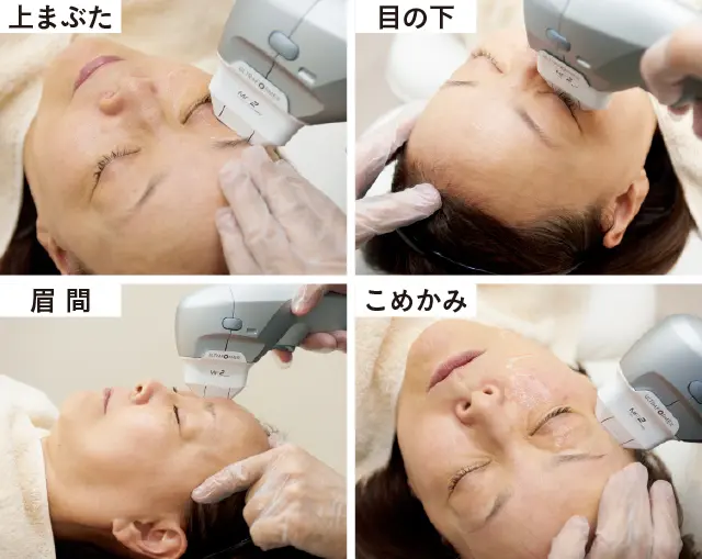 目もとハイフシャワーの施術中