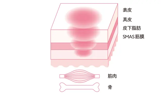 ボルニューマ（高周波）