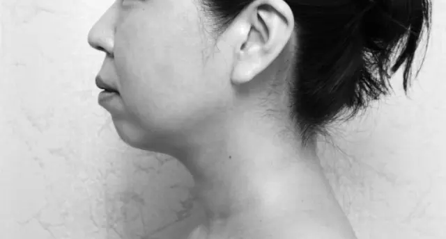 【施術直後】もたつきがすっきり！