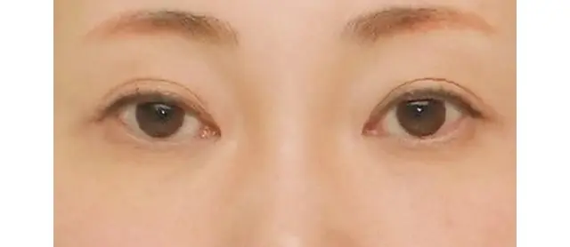 サーマクールアイ　施術前