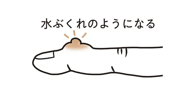 指の第1関節の近くに水ぶくれのような透き通った出っぱりができることもある