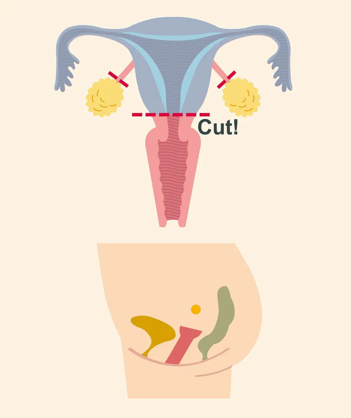 OurAge×Webエクラ　稀に子宮頸部を残すことも…