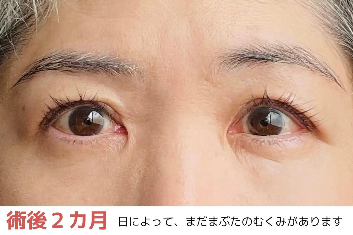 OurAge×Webエクラ　術後2ヵ月　日によって、まだまぶたのむくみがあります