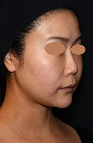 OurAge×Webエクラ　AFTER 2週間