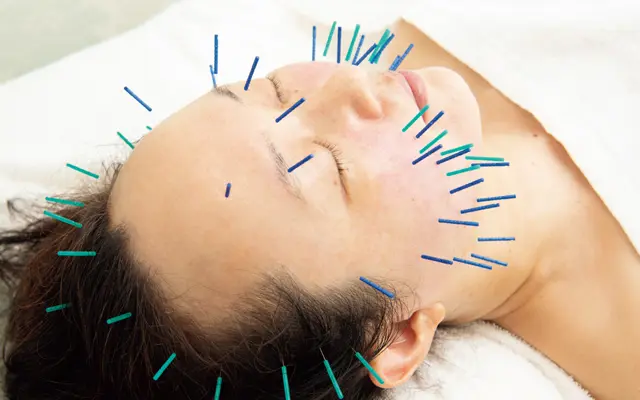マッサージ後のリフト感をさらに盤石なものにするために、頭皮や顔全体に美容鍼を刺す。