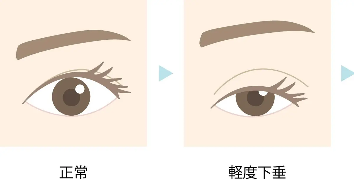 OurAge×Webエクラ　【MRDの診断基準】