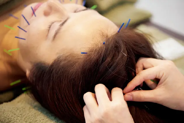 鍼は頭皮や足、おなかにも！