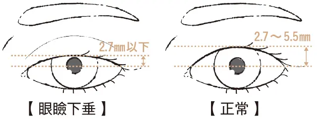 眼瞼下垂の疑い
