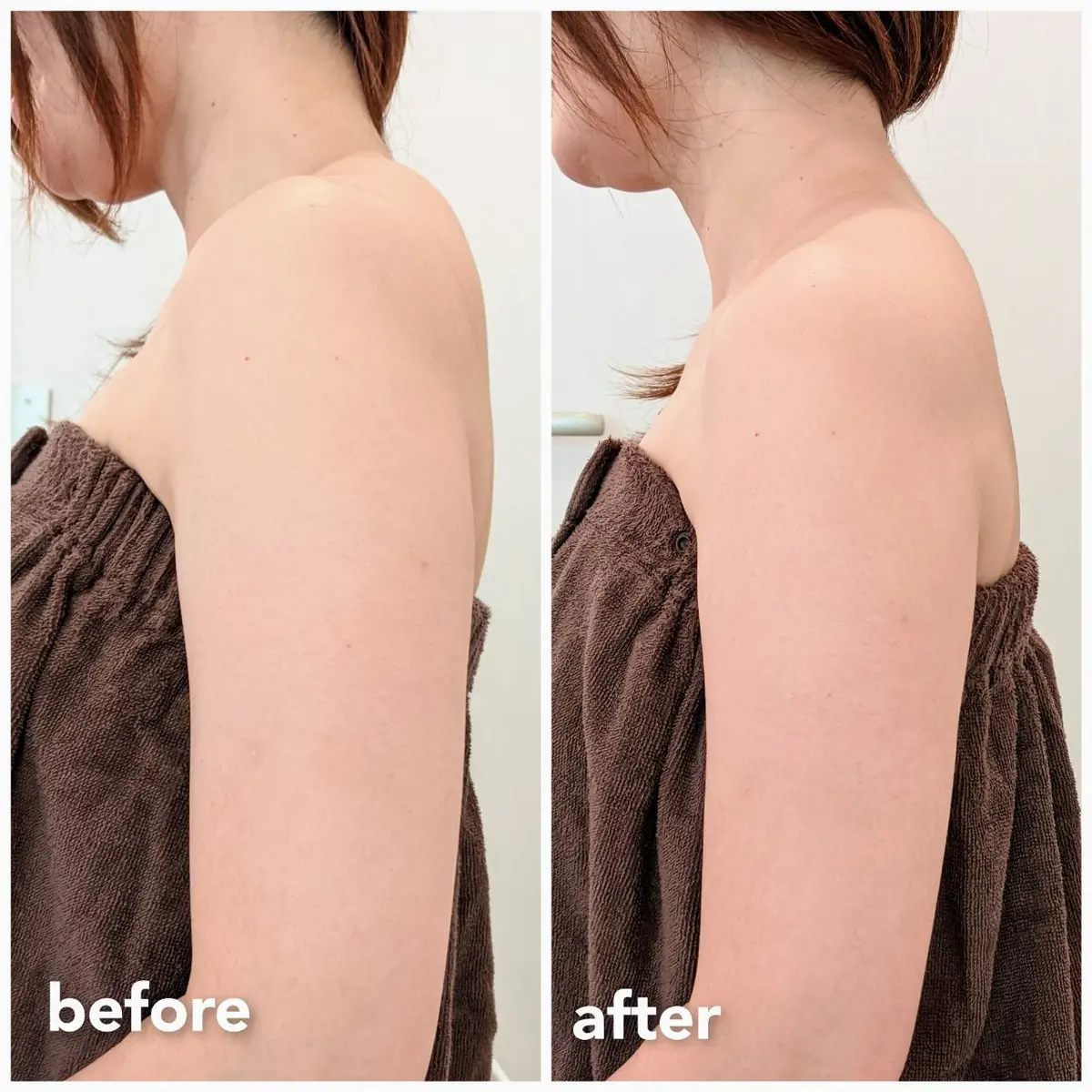 二の腕　エステの前後の写真