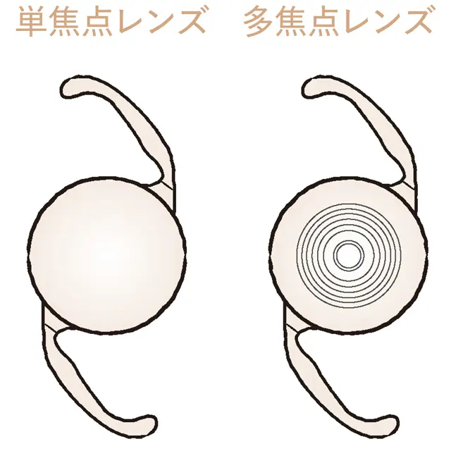 眼内レンズには多焦点と単焦点がある。