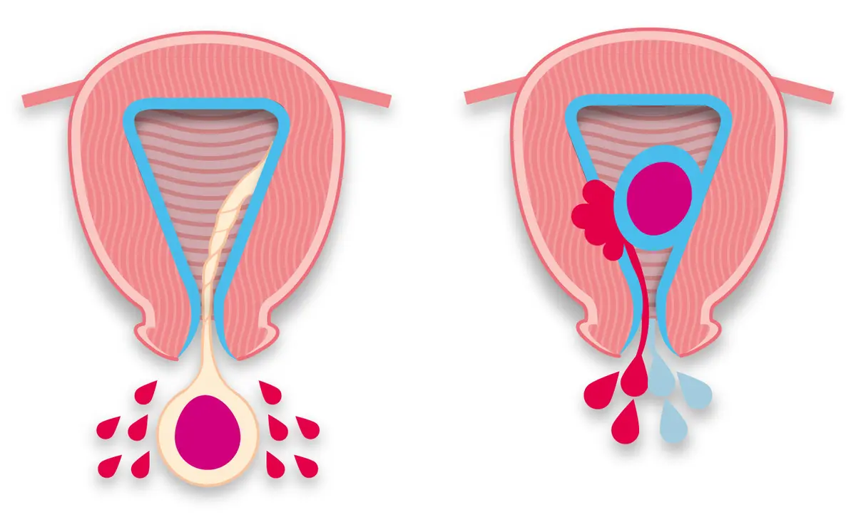 OurAge×Webエクラ　粘膜下筋腫