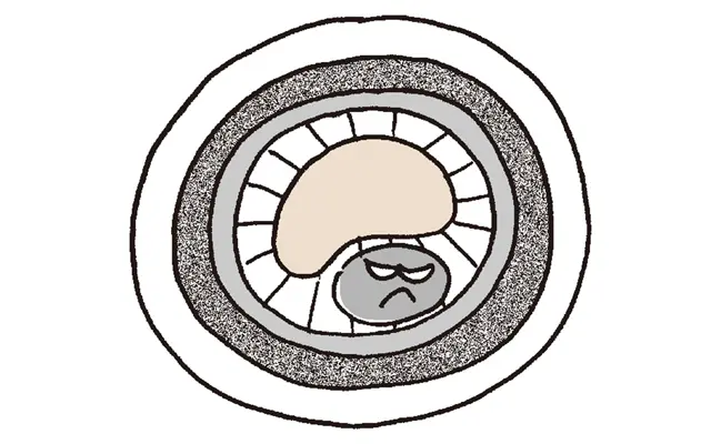 コレステロール値急上昇