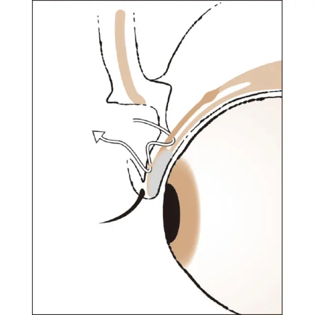 挙筋腱膜縫着術