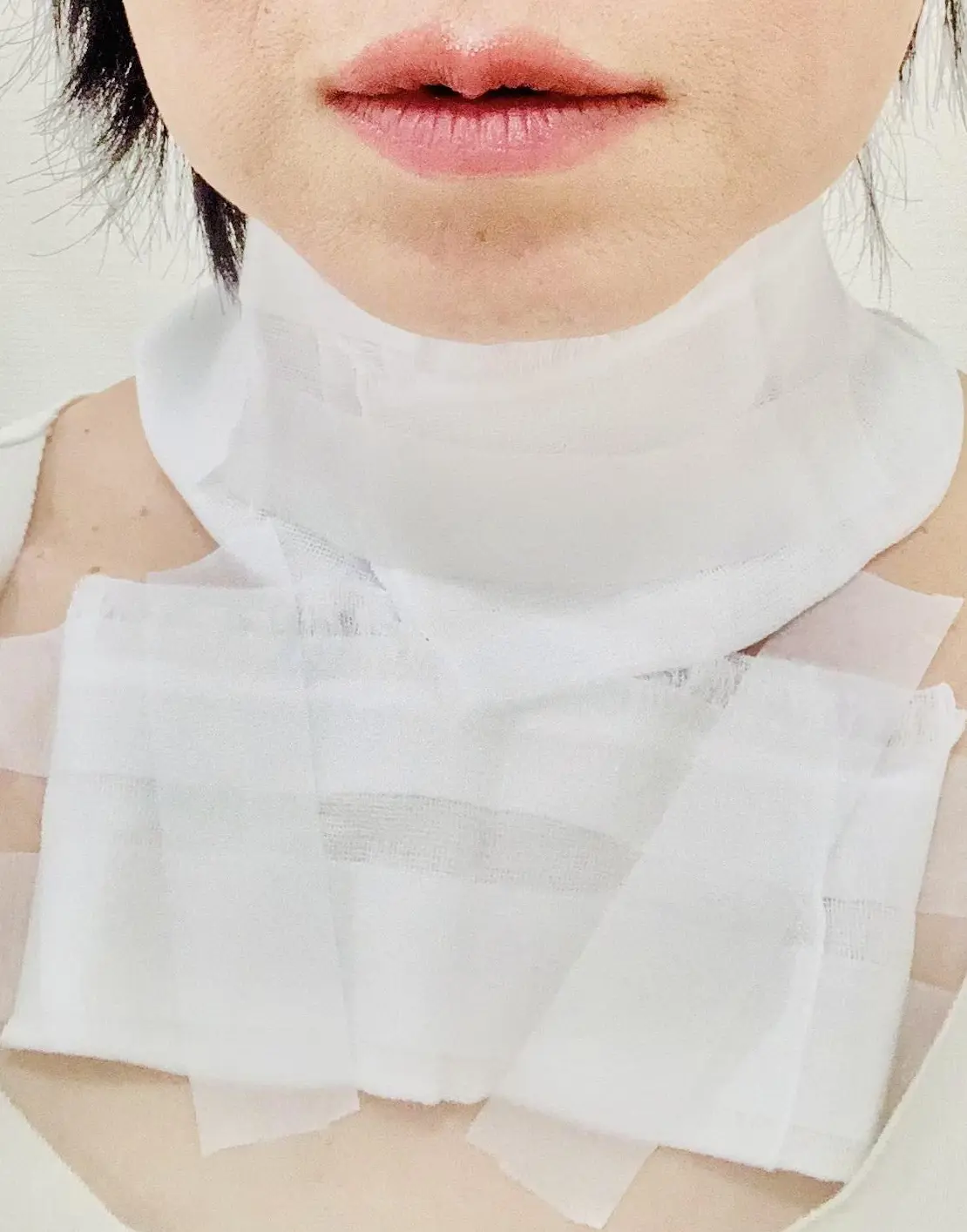 スキンタッグ(首のイボ）を取った話の画像_1