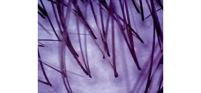 1回のプログラムで、頑固な汚れがクリアになっている。また頭皮が保湿され、健康的な白っぽい色に変化した。