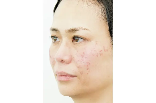 「初めてのシミとり」施術体験レポート②年の画像_5