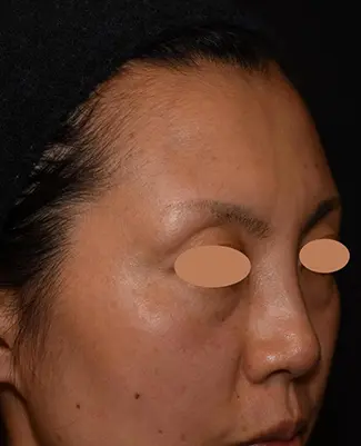 OurAge×Webエクラ  40代女性BEFORE