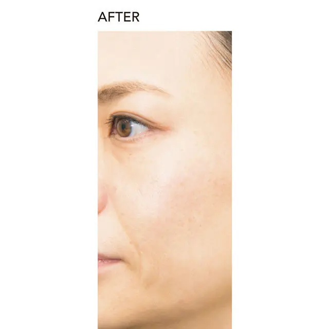 「美容クリニックでシミとり」企画の2年後の点在ジミを追ってみた！（体験者／エクラエディター K野）