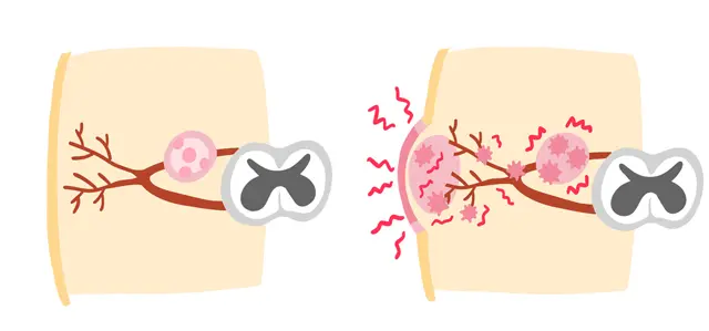 なぜ発症するのか？