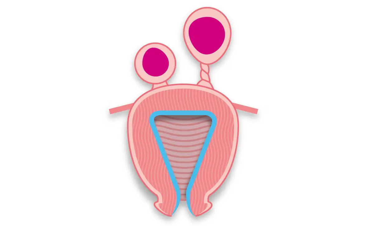 OurAge×Webエクラ　漿膜下（しょうまくか）筋腫