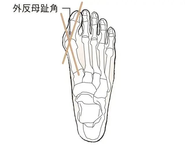 外反母趾