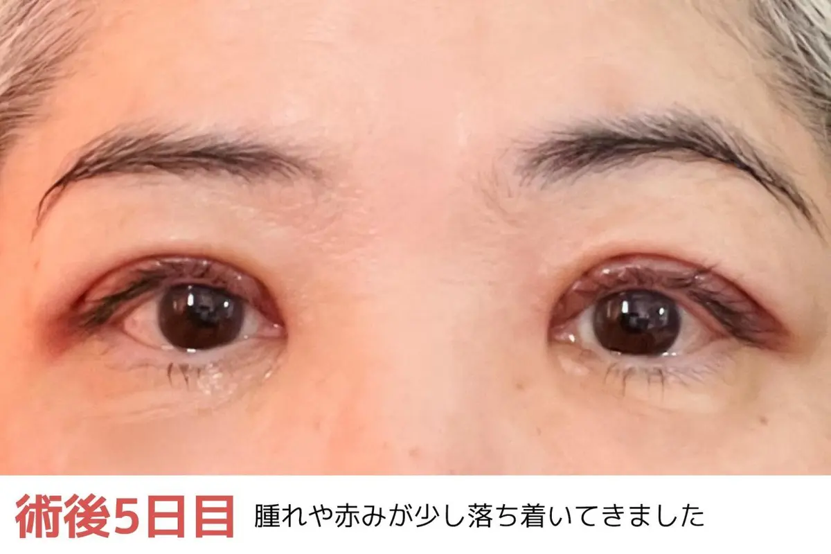 OurAge×Webエクラ　術後5日目　腫れや赤みが少し落ち着いてきました