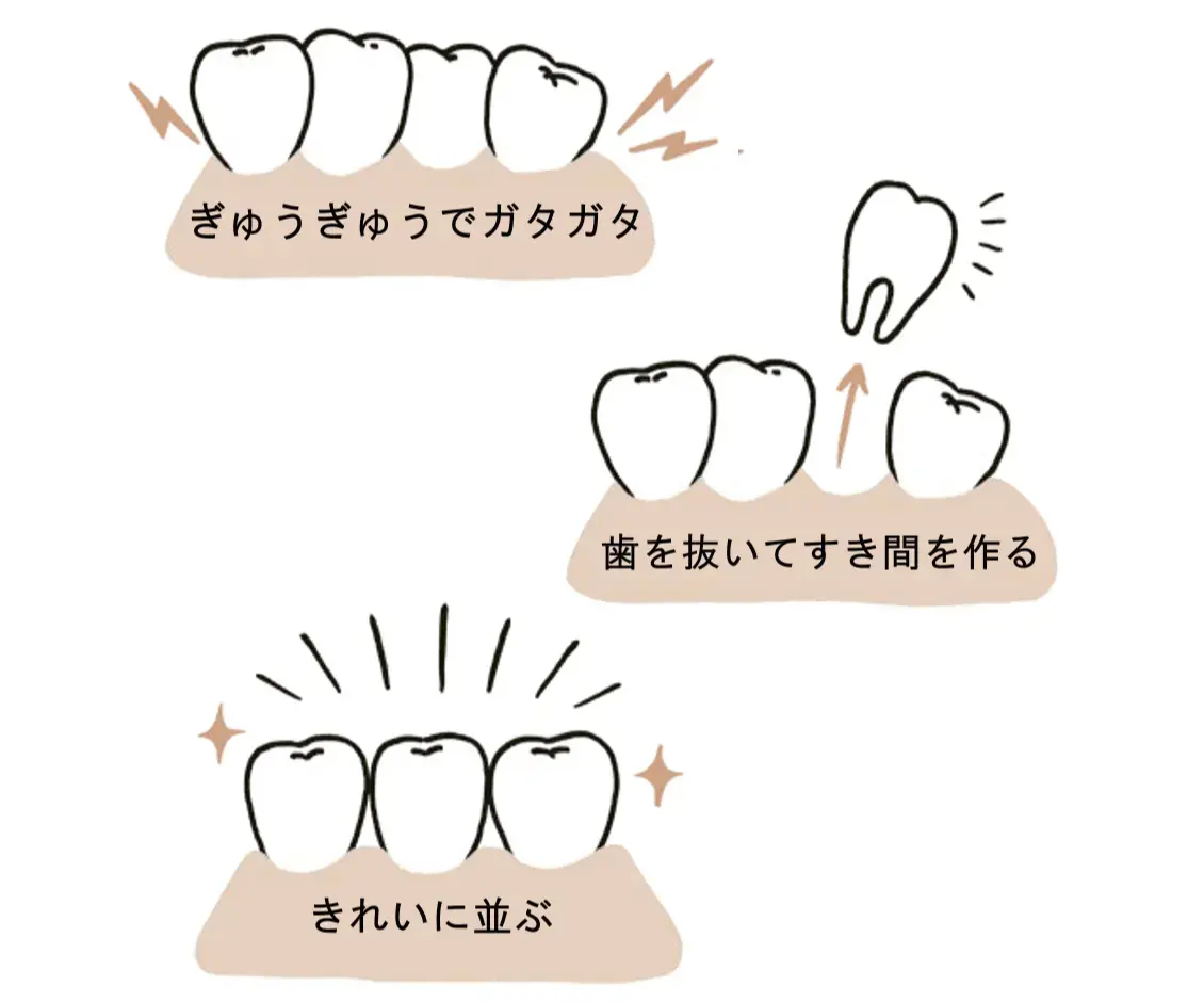 矯正前に親知らず4本の抜歯が必要!?