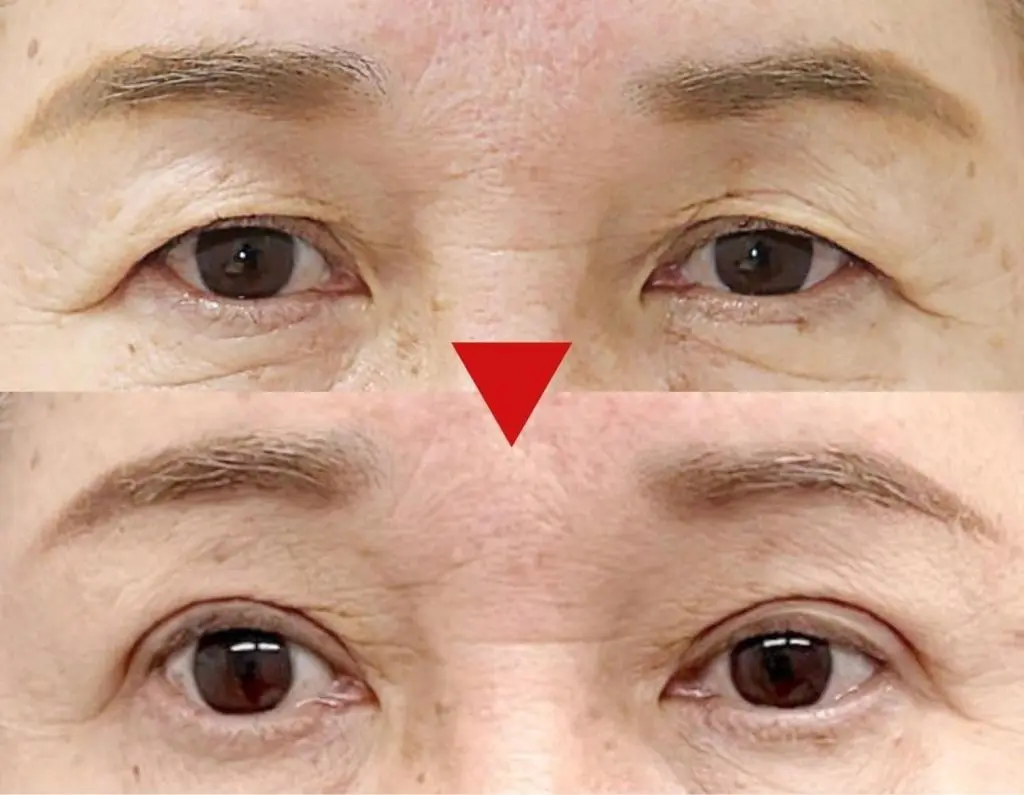 OurAge×Webエクラ　麻生先生による症例：切開による眼瞼下垂手術と、目の下のたるみ取りをした60代女性。  下は術後7カ月