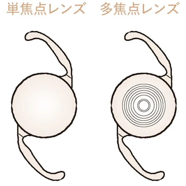 眼内レンズには多焦点と単焦点がある。単焦点レンズはピントが合う距離が一カ所で、＂遠方＂を選んだ場合、近いものを見るときはメガネが必要になる。多焦点レンズはゆるやかなピントで全域見えるが価格が高く、保険適用手術になりにくい。