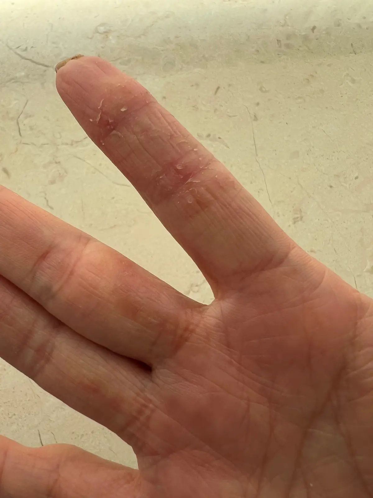 主婦手湿疹。中指のつけ根のカサついていた部分はスベスベに。