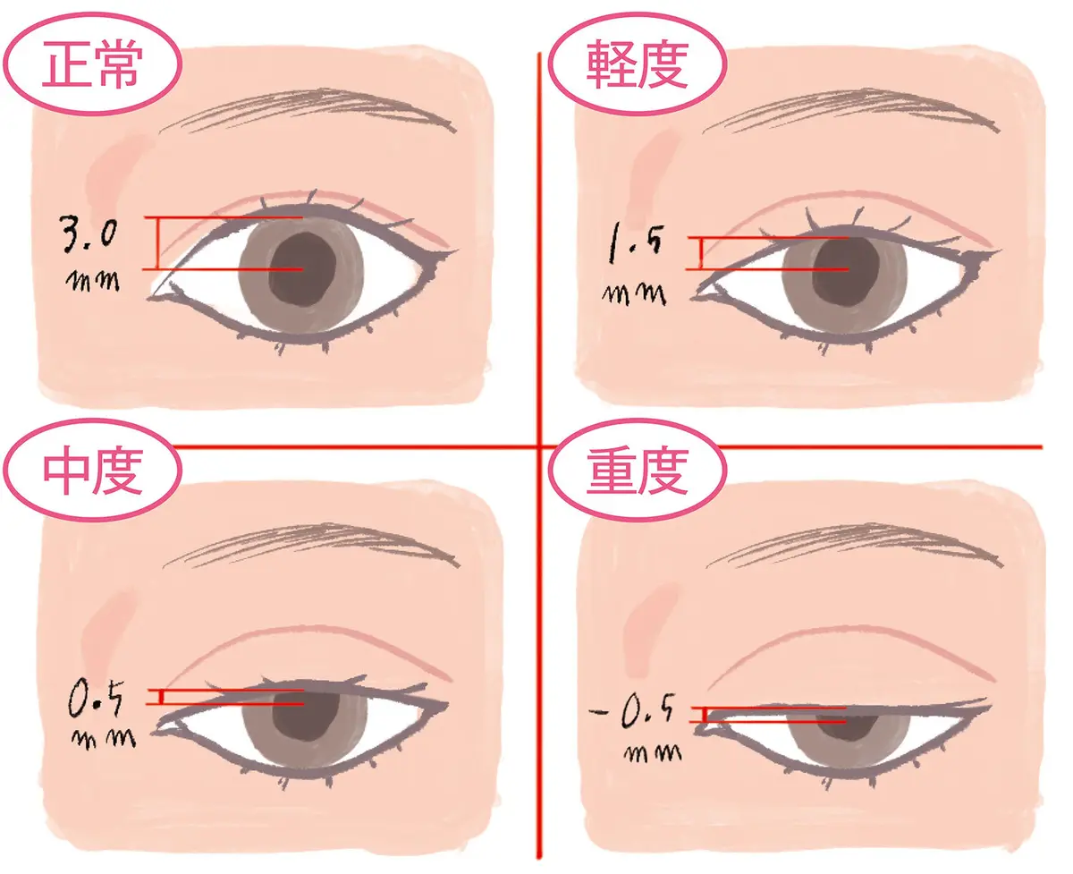OurAge×Webエクラ　MRDによる眼瞼下垂の判定