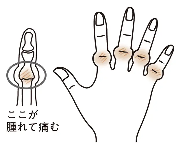 ブシャール結節