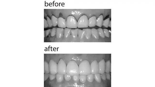 さし歯の歯茎の境目から、歯の根元が見える上のさし歯をセラミッククラウンに。天然歯のよう