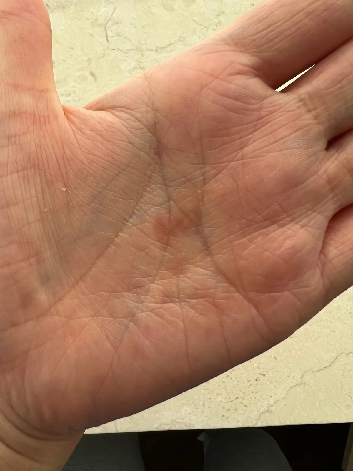 手のひらの皮ムケがなくなり、地図みたいな赤みも引きました。