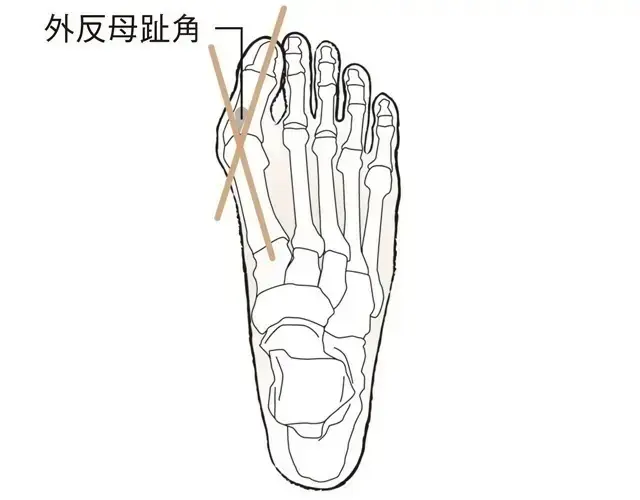 親指が外に曲がり、つけ根が突出【外反母趾（がいはんぼし）】
