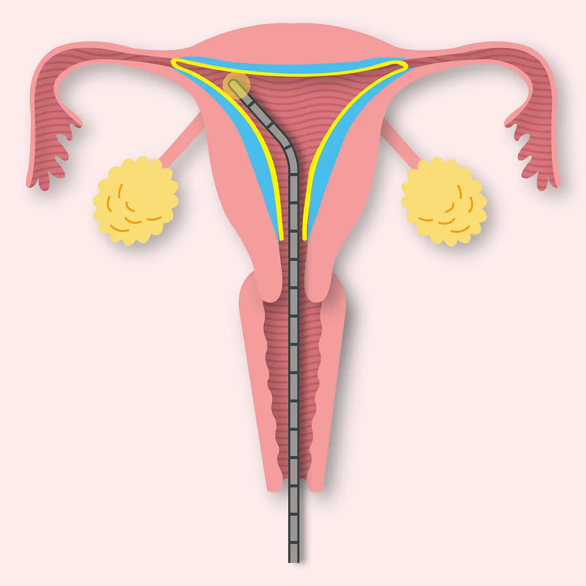 OurAge×Webエクラ　MEA（マイクロ波子宮内膜アブレーション）