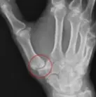 母指CM関節がずれている。