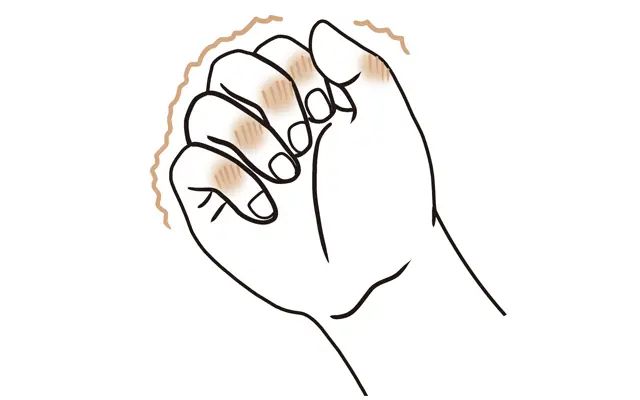 へバーデン結節3