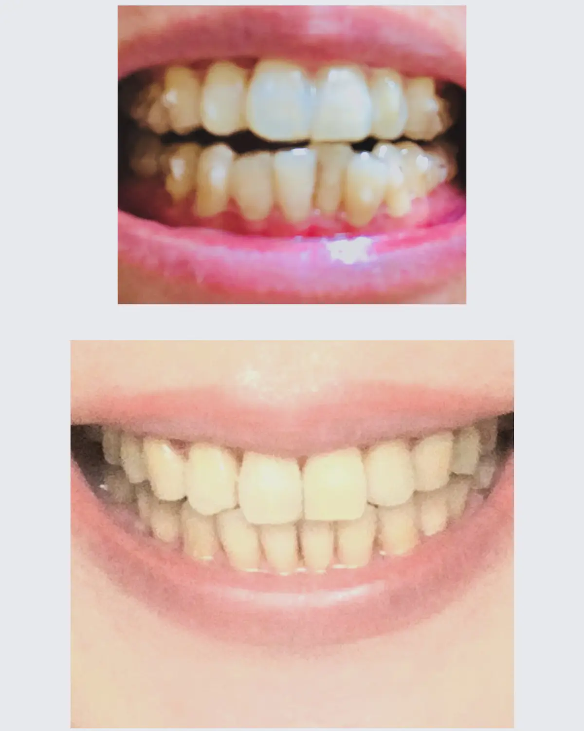 歯磨き粉でホワイトニング✨の画像_1