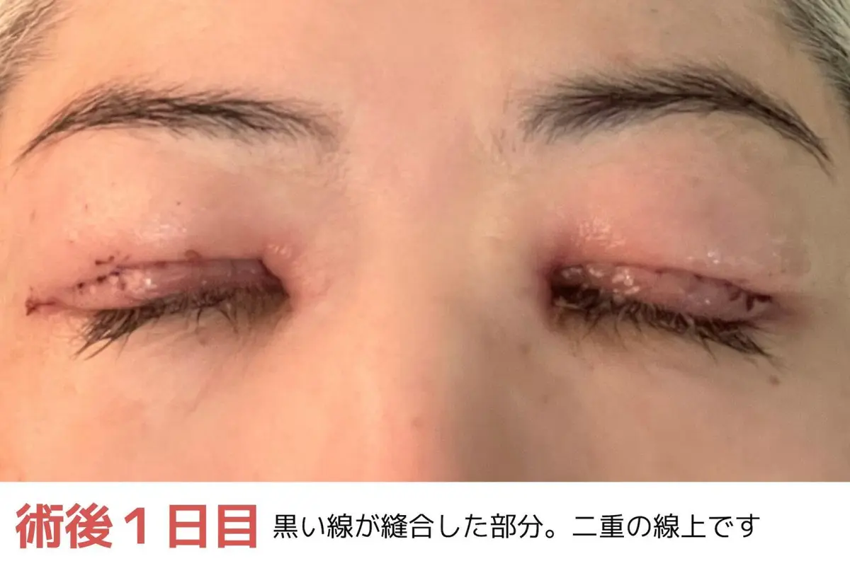 OurAge×Webエクラ　術後1日目　黒い線が縫合した部分。二重の線上です