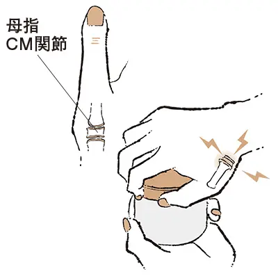 更年期の手指問題