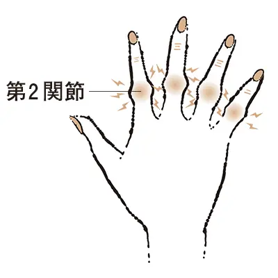 5. 第2関節がこぶ状に膨らむ “ブシャの画像_1