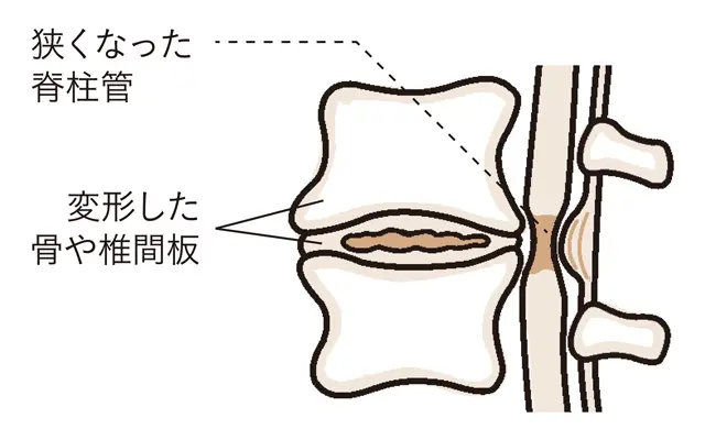 腰部脊柱管狭窄症