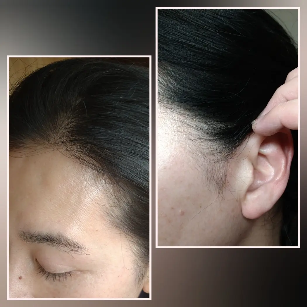 リライズ使用の生え際