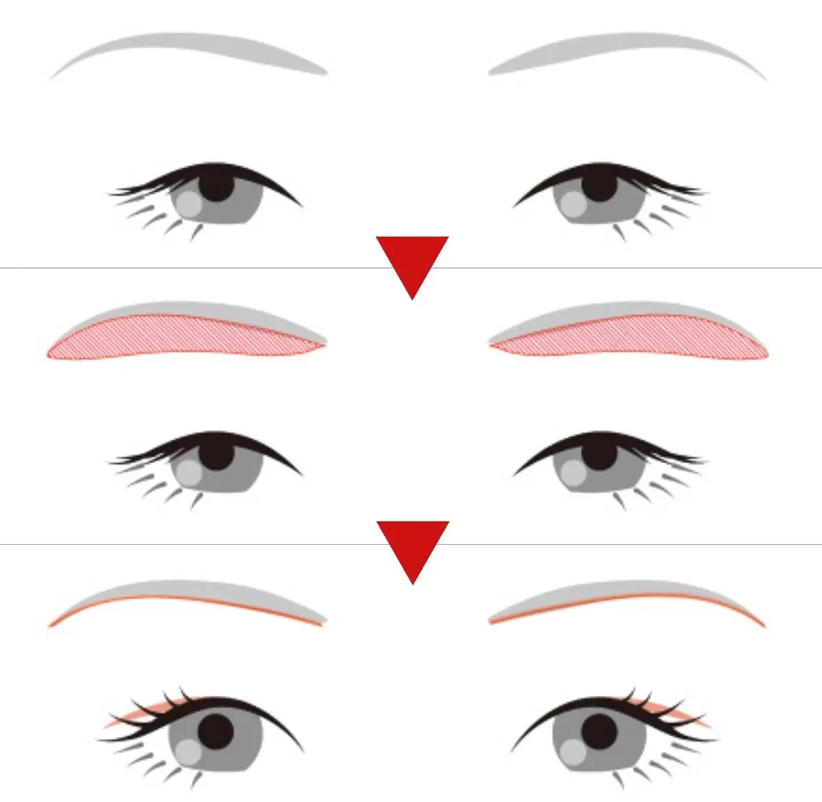 OurAge×Webエクラ　眉下切開術