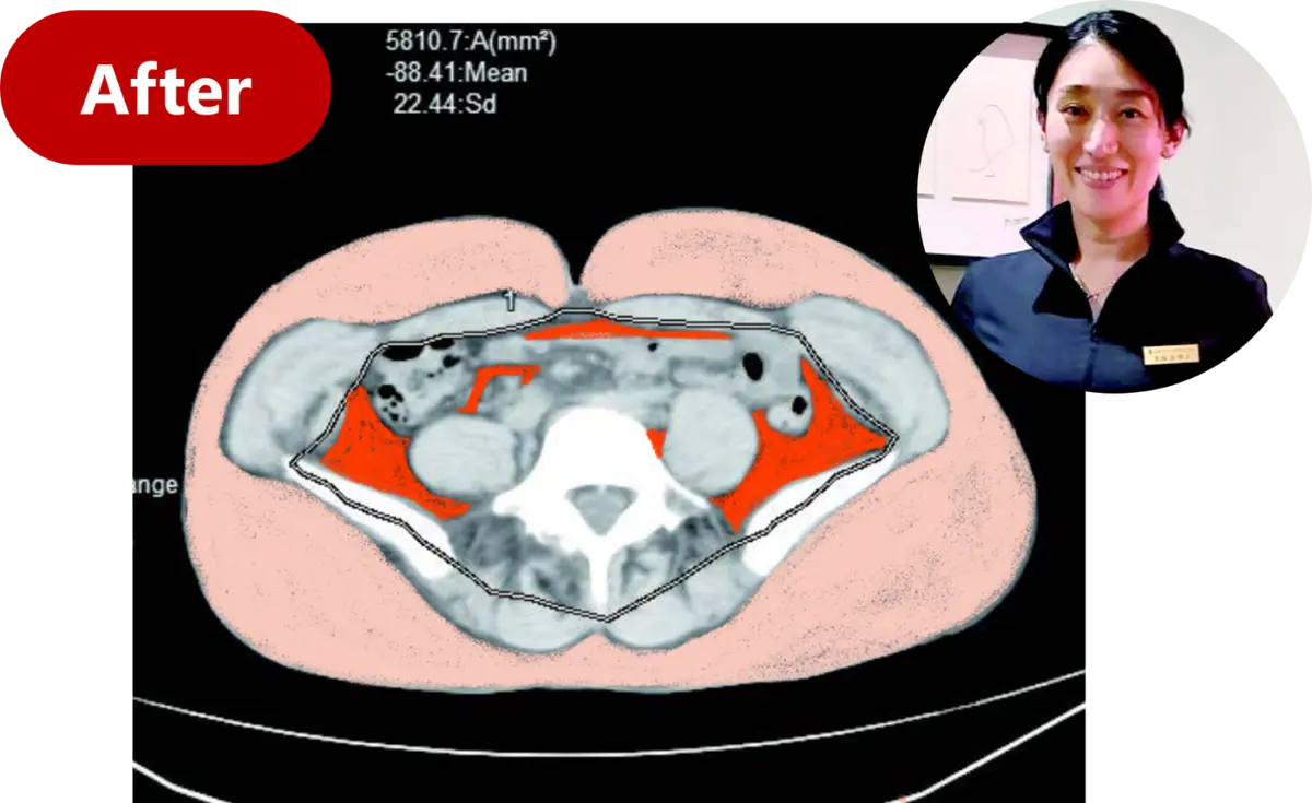 OurAge×Webエクラ　AFTER 内臓脂肪……  58.10㎠ 皮下脂肪……245.41㎠ 合計 …………303.51㎠